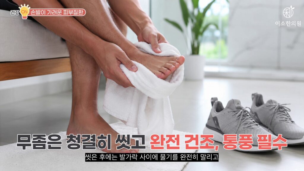 무좀은 청결히 씻고 완전 건조, 통풍 필수