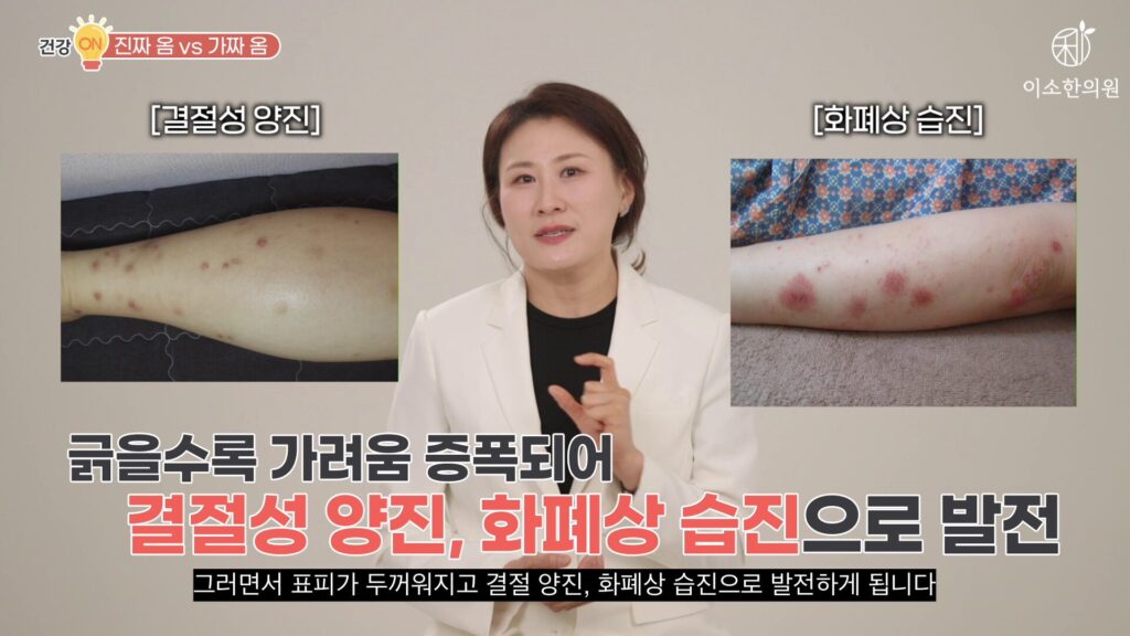 결절성 양진, 화폐상 습진으로 발전