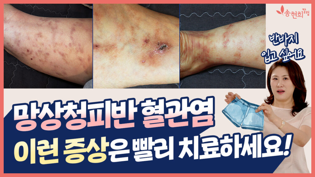 망상청피반 혈관염