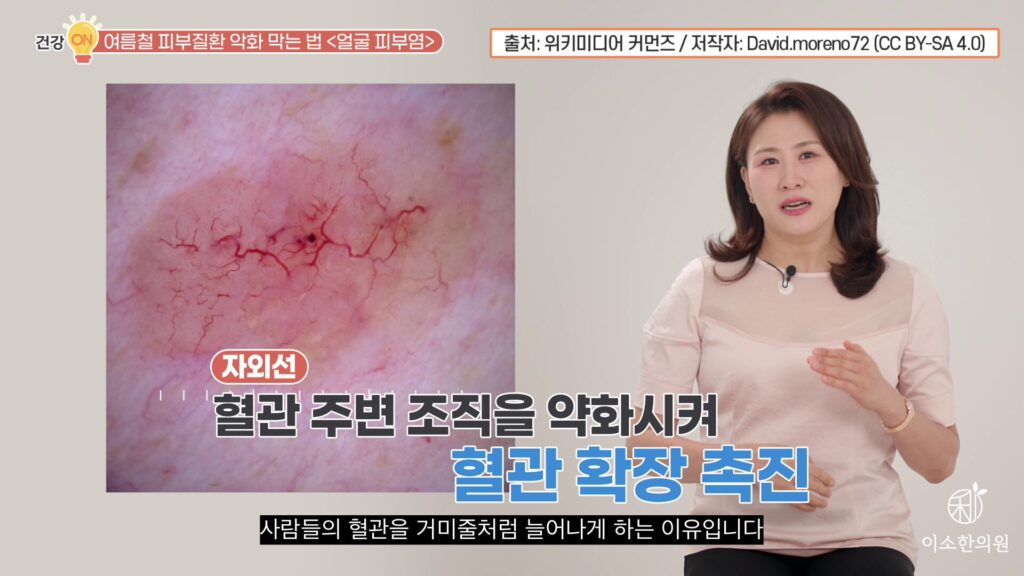 자외선은 혈관 확장 촉진
