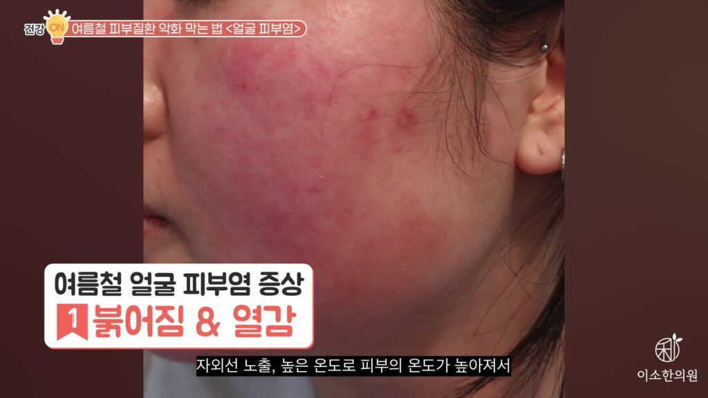 붉어짐과 열감