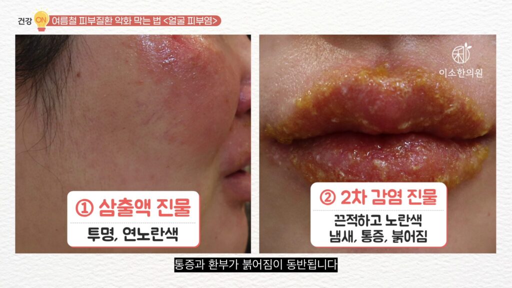 삼출액 진물과 2차 감염 진물