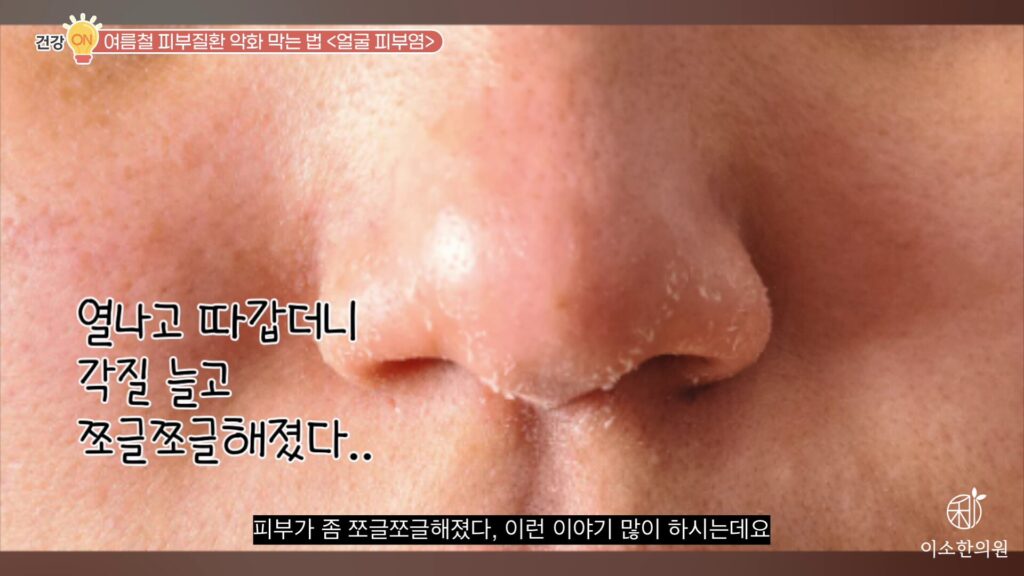 하얗게 들뜨는 각질