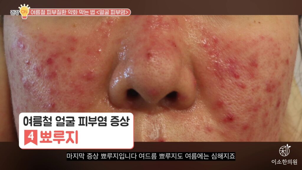 뾰루지
