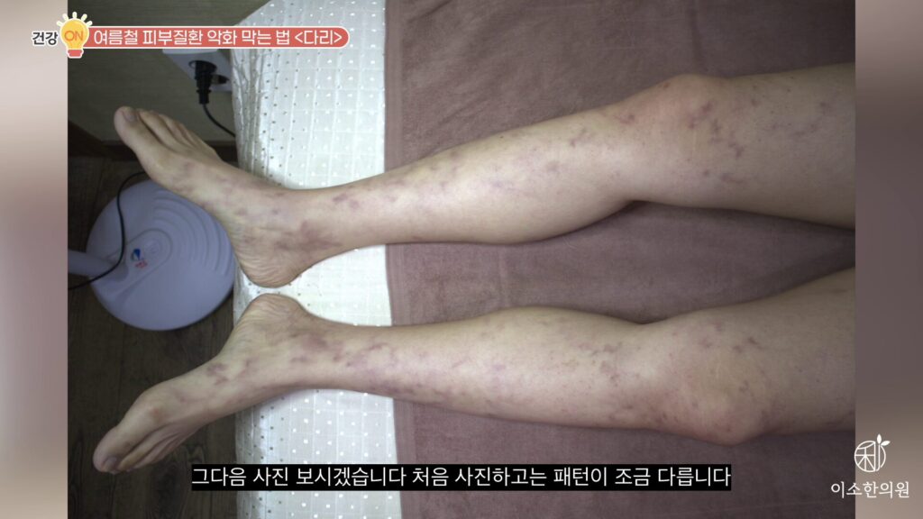 울혈반 모양 혈관염