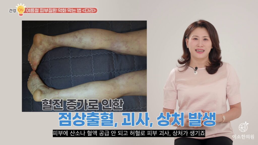 청피반성 혈관염
