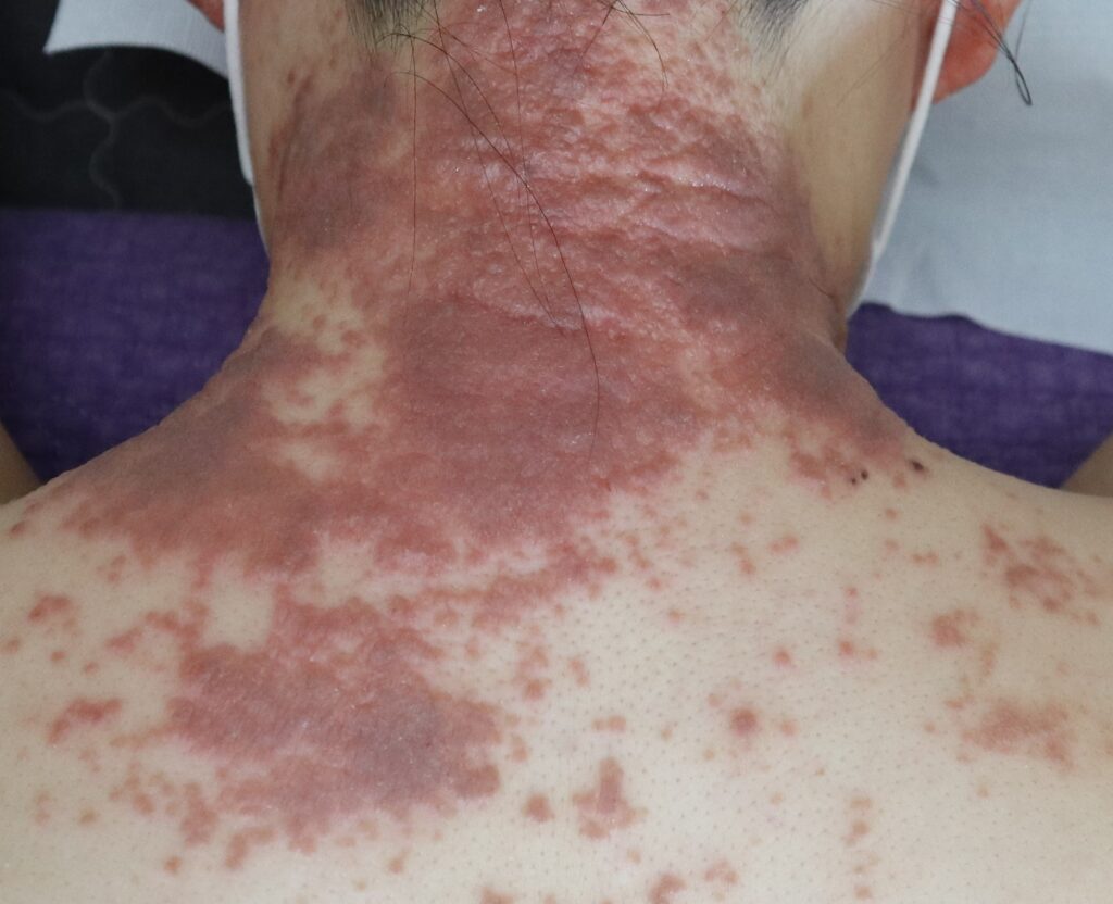 스테로이드부작용, ,레드스킨신드롬(Red skin syndrom)
