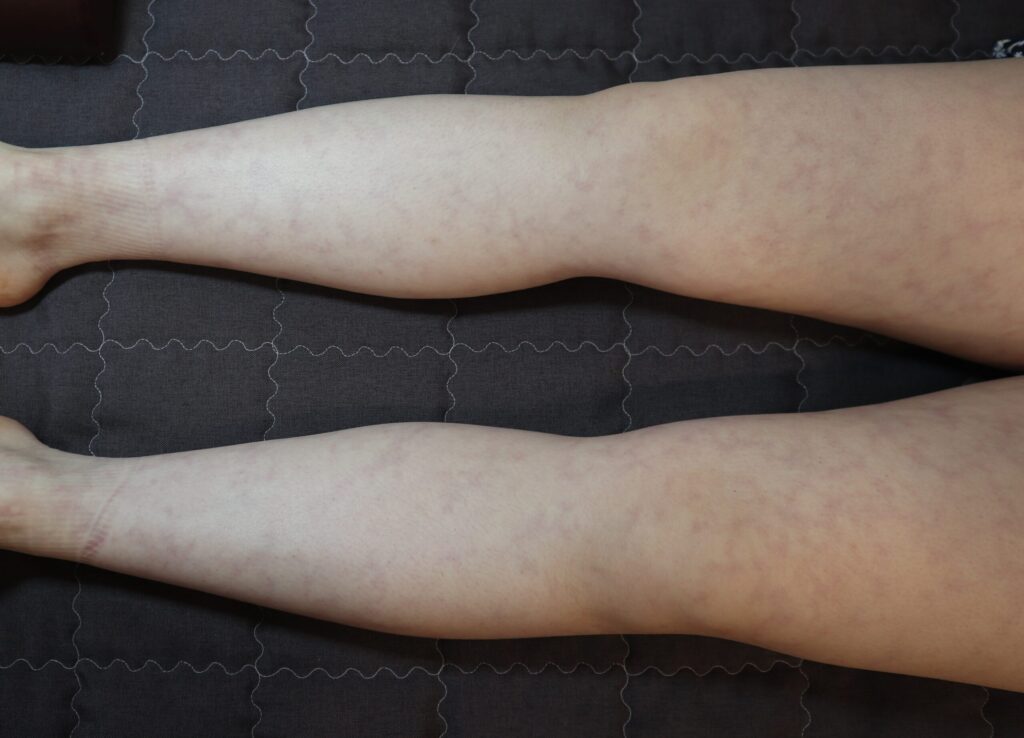조밀한 그물 모양 망상청피반