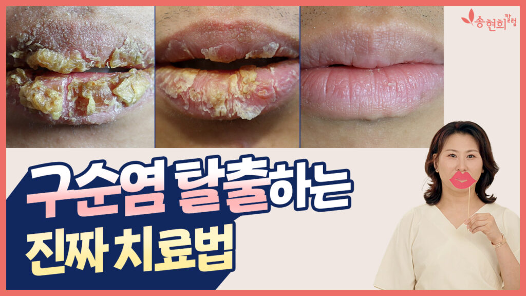 구순염 탈출하는 진짜 치료법