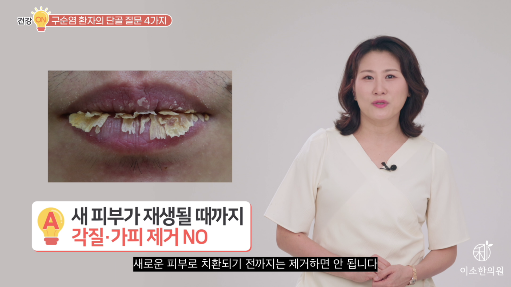 각질, 가피 제거 금지