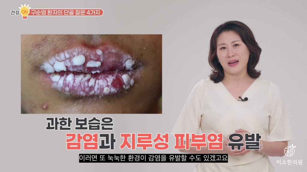 과한 보습은 감염과 지루성 피부염 유발
