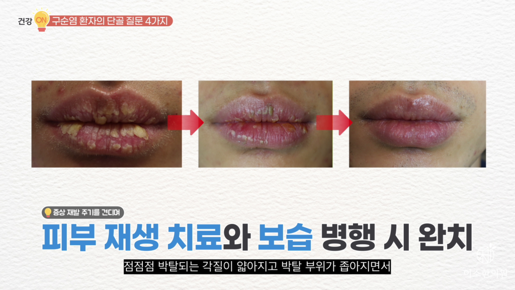 피부 재생 치료와 보습 병행 시 완치