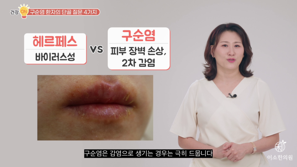 헤르페스와 구순염 차이