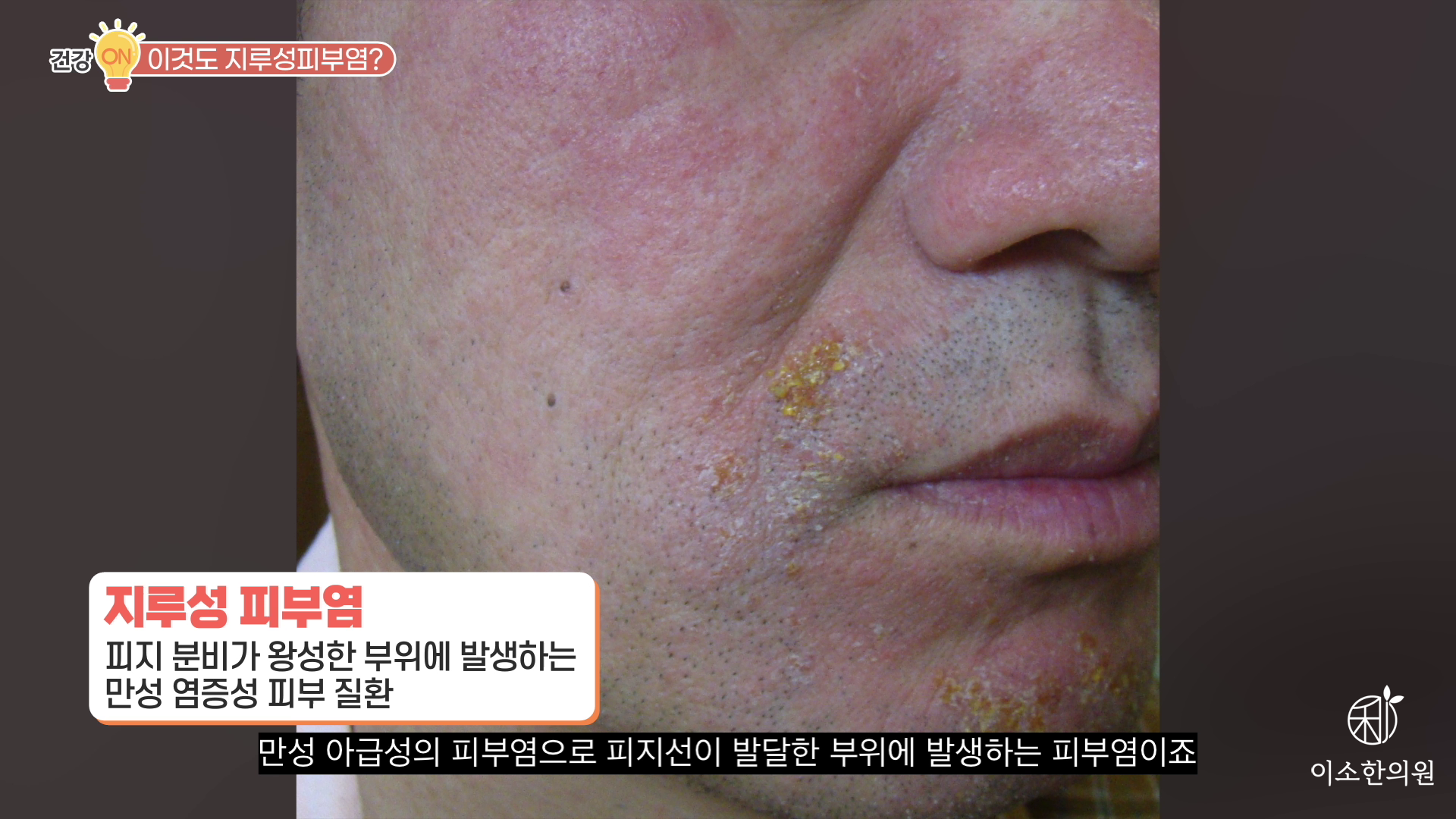 지루성 피부염 정의