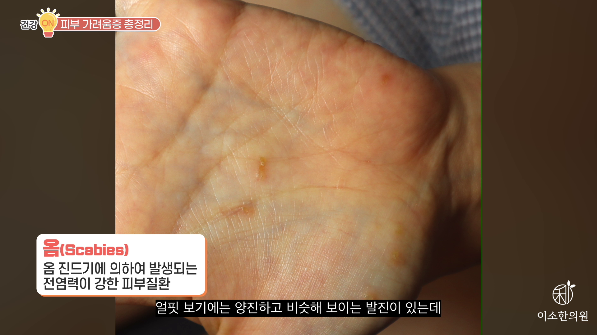옴(Scabies)