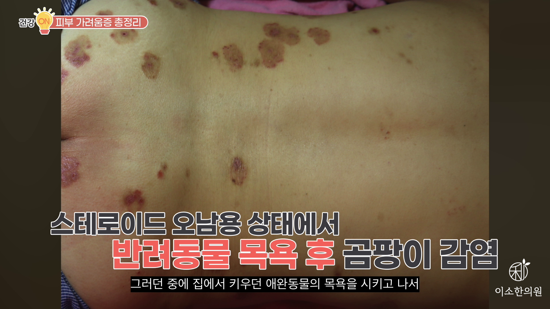 스테로이드 오남용 상태에서 반려동물 목욕 후 곰팡이 감염