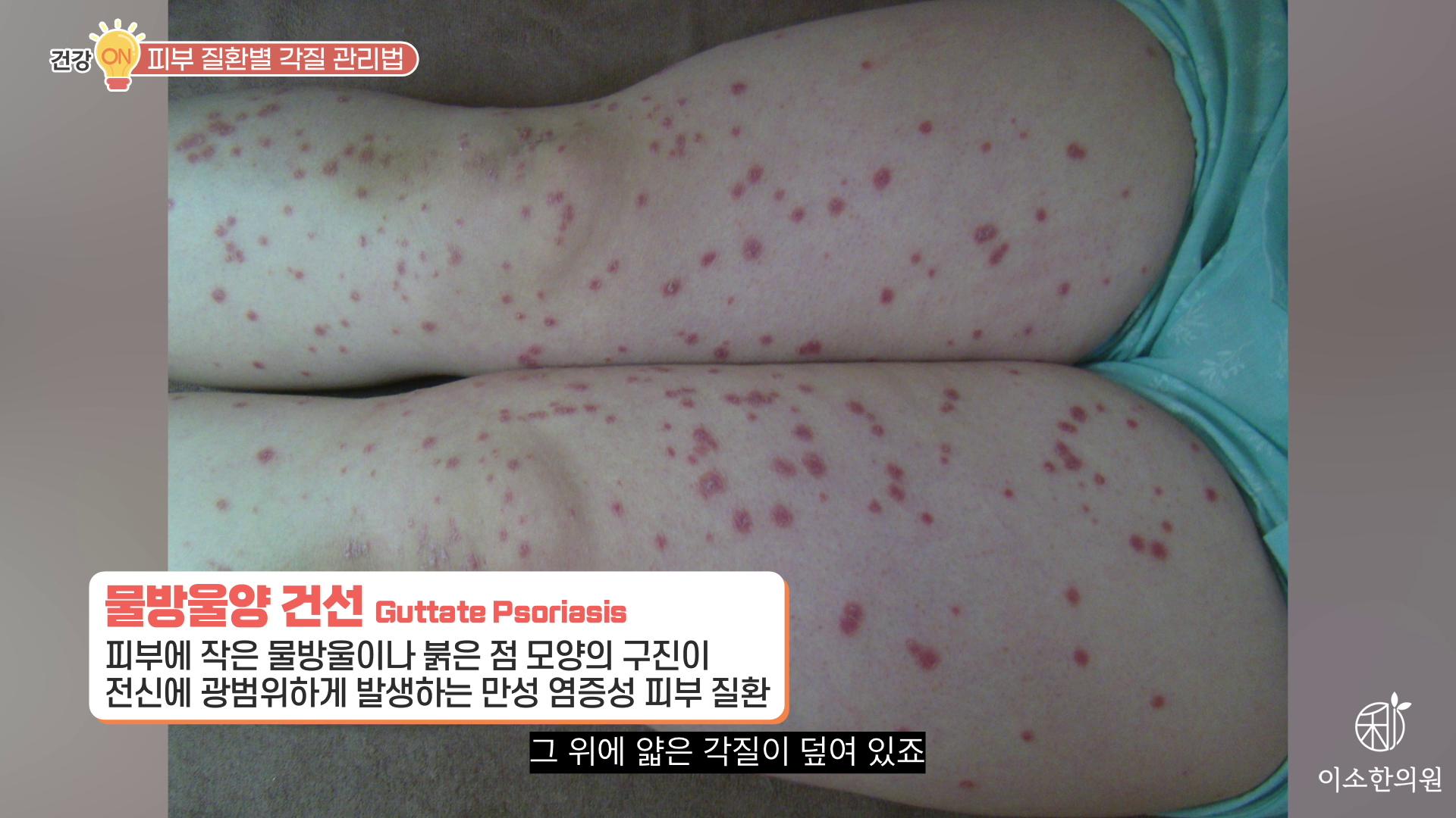 물방울양 건선