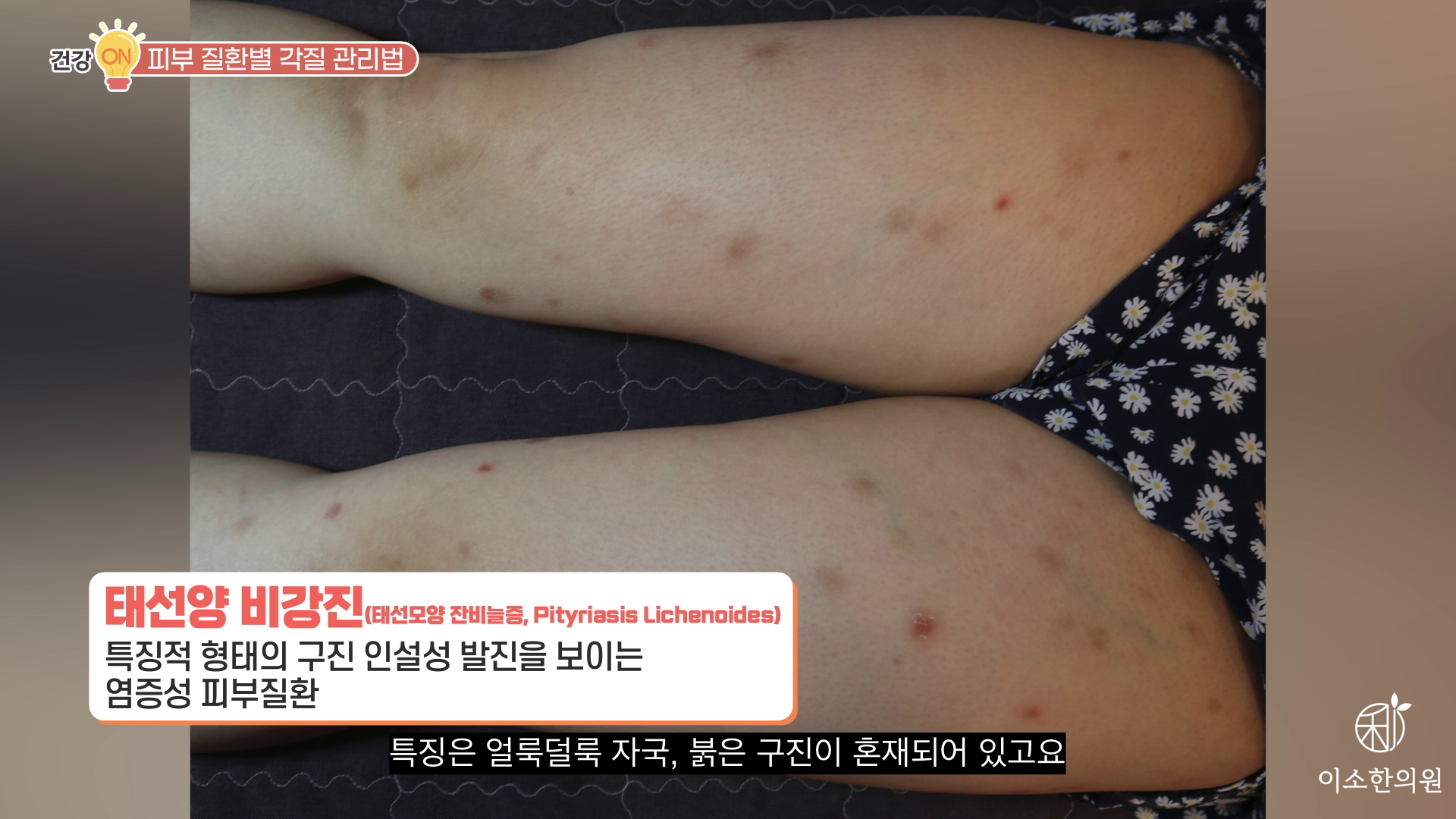 태선양 비강진