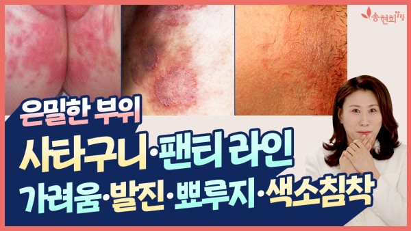 사타구니, 팬티라인