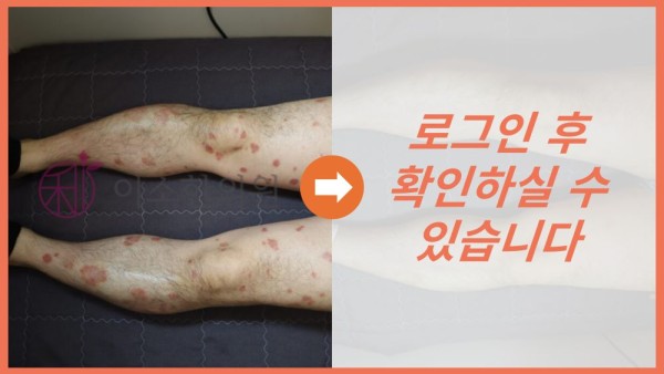 건선 전신 전후사진
