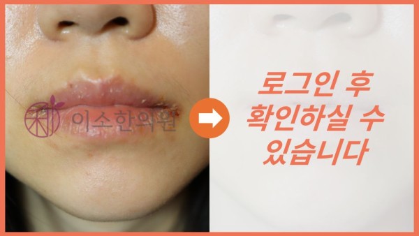 구순염 전후사진