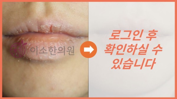 구순염 전후사진