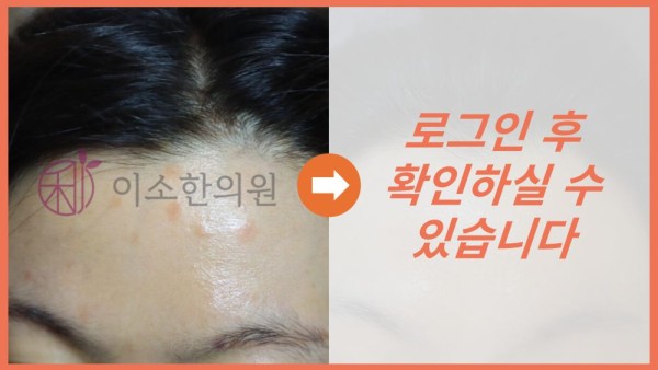 두피건선 전후사진
