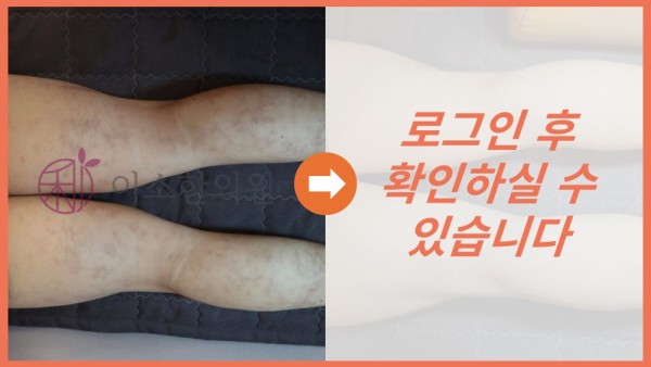 망상청피반 전후사진