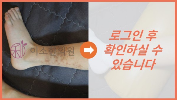 소아 스테로이드 전후사진