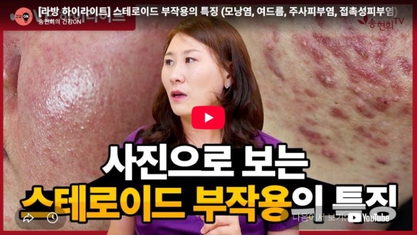스테로이드 부작용