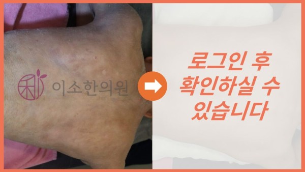 아토피 피부염 전후사진
