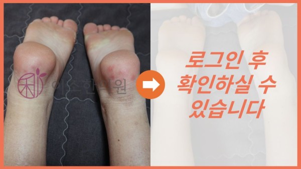 울혈반모양혈관염 치료 전 후 사진