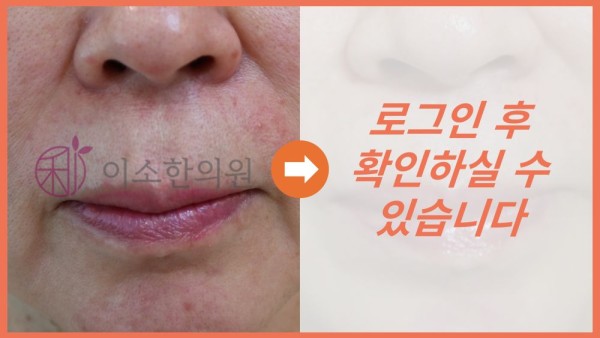 주사피부염 전후사진