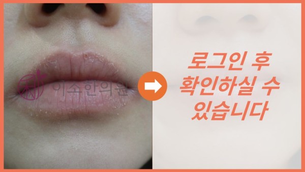 구순염 전후사진