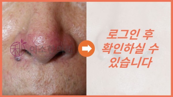 주사비 딸기코