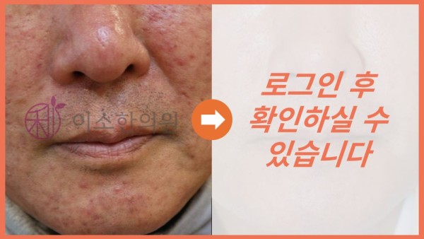 주사피부염 전후사진
