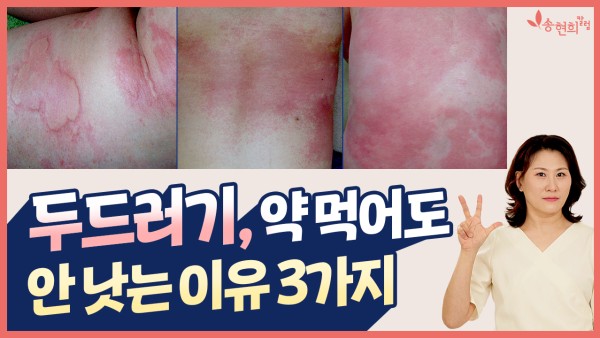 두드러기, 약 먹어도 안 낫는 이유 3가지