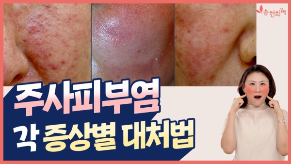 주사피부염 각 증상별 대처법