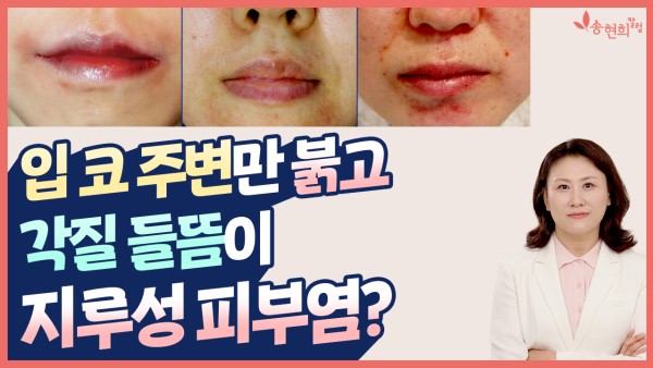 입, 코 주변만 붉고 각질 들뜸이 지루성 피부염?